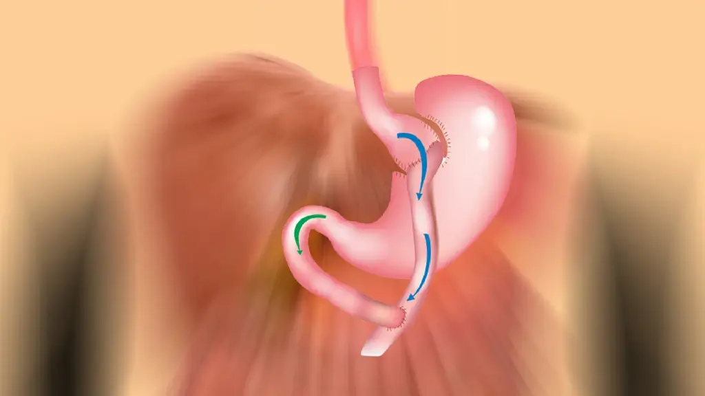 How to Find the Best Gastric Sleeve Turkey Price Without Compromising Quality